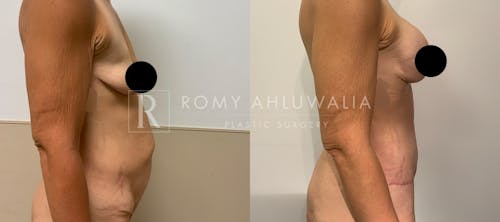 Before & After Result of Tummy Tuck Patient #35