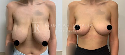 Before & After Result of Breast Reduction Patient #32