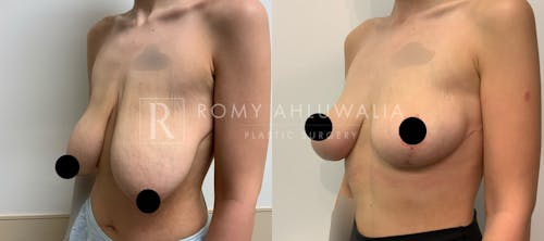 Before & After Result of Breast Reduction Patient #32