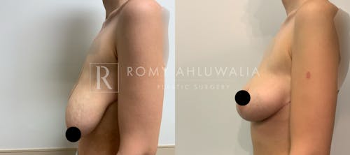 Before & After Result of Breast Reduction Patient #32