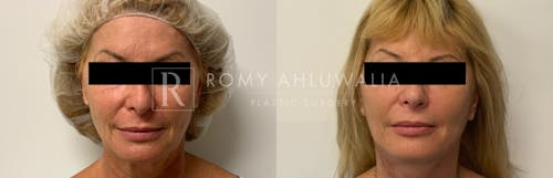 Before & After Result of Facelift Patient #6