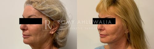 Before & After Result of Facelift Patient #6