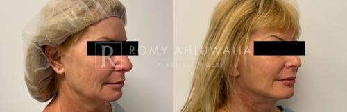Before & After Result of Facelift Patient #6