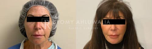 Before & After Result of Facelift Patient #8
