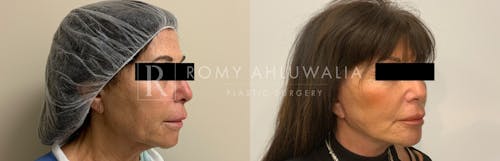 Before & After Result of Facelift Patient #8