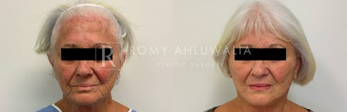 Before & After Result of Mini Facelift (No General Anesthesia) Patient #15