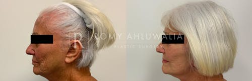 Before & After Result of Mini Facelift (No General Anesthesia) Patient #15