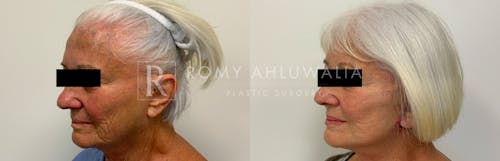 Before & After Result of Mini Facelift (No General Anesthesia) Patient #15