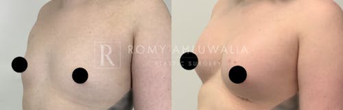 Before & After Result of Breast Augmentation Patient #14
