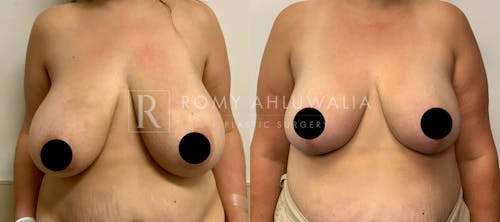 Before & After Result of Breast Reduction Patient #17