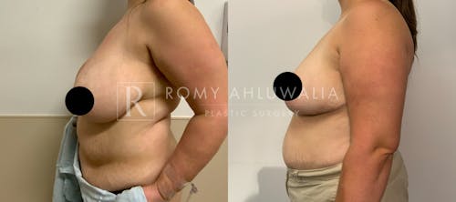 Before & After Result of Breast Reduction Patient #17