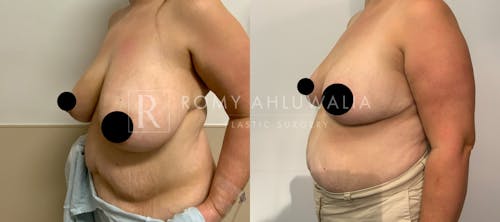 Before & After Result of Breast Reduction Patient #17