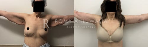 Before & After Result of Arm Lift Patient #1