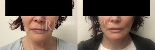 Before & After Result of Revision Facelift Patient #14