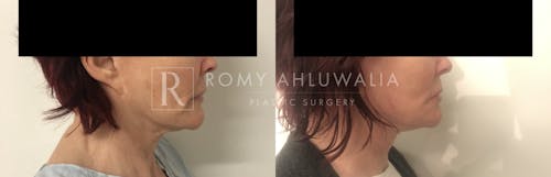 Before & After Result of Revision Facelift Patient #14