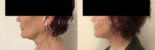 Before & After Result of Revision Facelift Patient #14