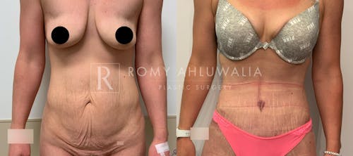 Before & After Result of Tummy Tuck Patient #36