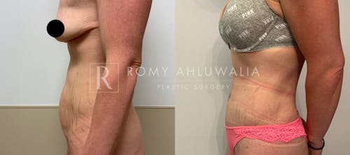 Before & After Result of Tummy Tuck Patient #36