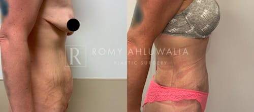 Before & After Result of Tummy Tuck Patient #36