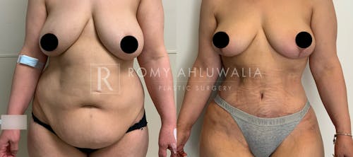 Before & After Result of Tummy Tuck Patient #37