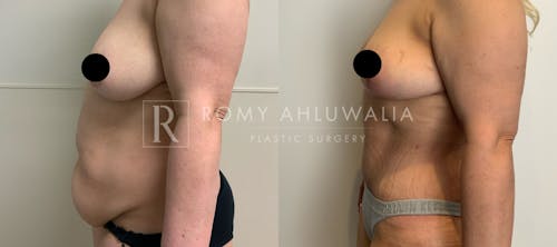 Before & After Result of Tummy Tuck Patient #37