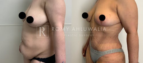 Before & After Result of Tummy Tuck Patient #37
