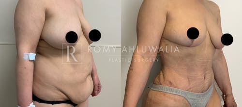 Before & After Result of Tummy Tuck Patient #37