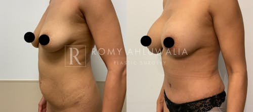 Before & After Result of Tummy Tuck Patient #34