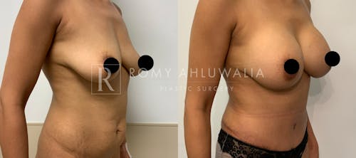 Before & After Result of Tummy Tuck Patient #34