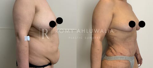 Before & After Result of Tummy Tuck Patient #37
