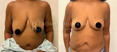 Before & After Result of Breast Reduction Patient #13