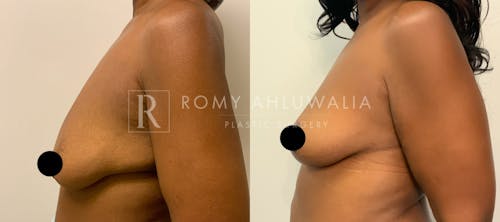 Before & After Result of Breast Reduction Patient #13