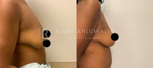 Before & After Result of Breast Reduction Patient #13