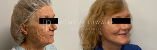 Before & After Result of Facelift Patient #1