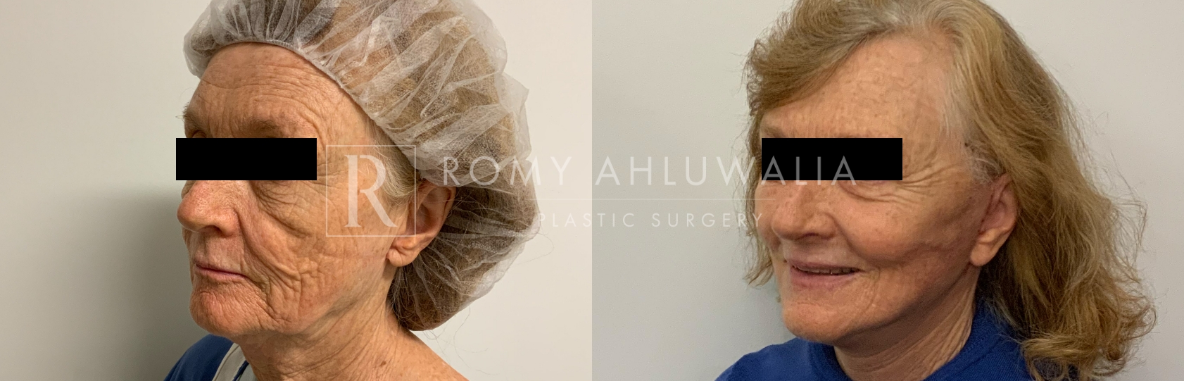 NanoLift Before and After