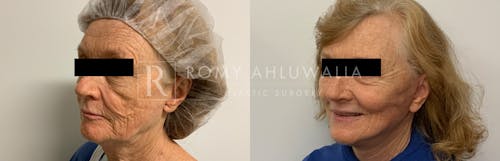Before & After Result of Facelift Patient #1