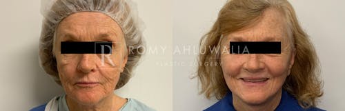 Before & After Result of Facelift Patient #1
