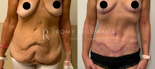 Before & After Result of Tummy Tuck Patient #30