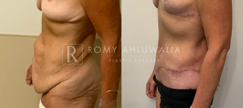 Before & After Result of Tummy Tuck Patient #30