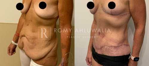 Before & After Result of Tummy Tuck Patient #30