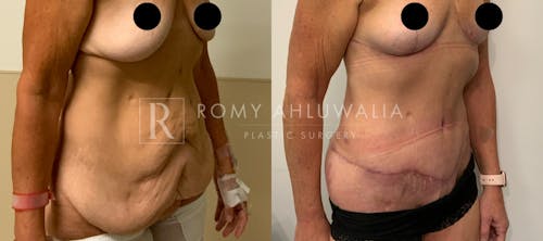 Before & After Result of Tummy Tuck Patient #30