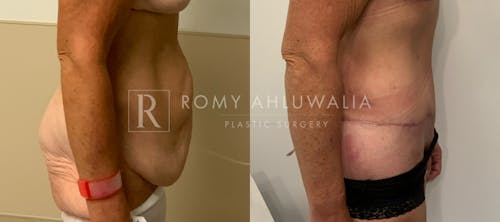 Before & After Result of Tummy Tuck Patient #30