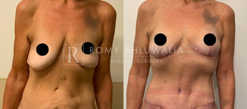 Before & After Result of Breast Reduction Patient #15
