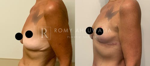 Before & After Result of Breast Reduction Patient #15