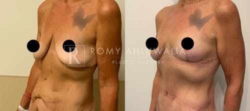 Before & After Result of Breast Reduction Patient #15