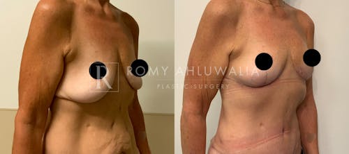 Before & After Result of Breast Reduction Patient #15
