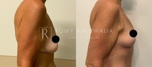 Before & After Result of Breast Reduction Patient #15
