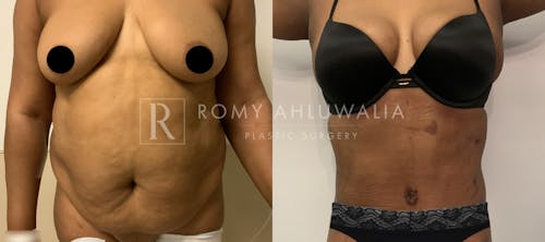 Before & After Result of Tummy Tuck Patient #38
