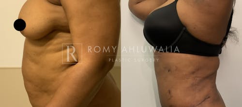 Before & After Result of Tummy Tuck Patient #38