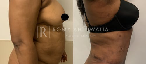 Before & After Result of Tummy Tuck Patient #38